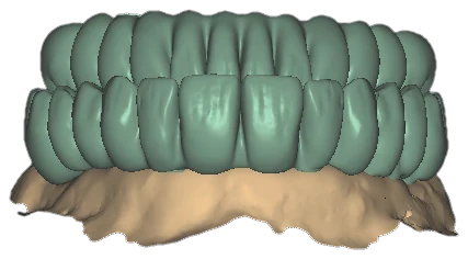 Frontal view of upper and lower teal wax-up arches in occlusion over sandy soft tissue