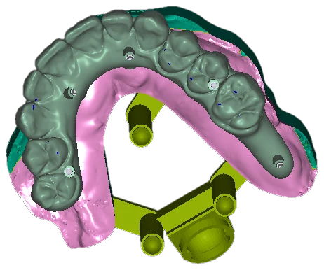 Occlusal view of a full-arch conversion prosthesis on implants: pink gingiva, gray teeth with screw-access markers, teal substructure, yellow mounting jig below