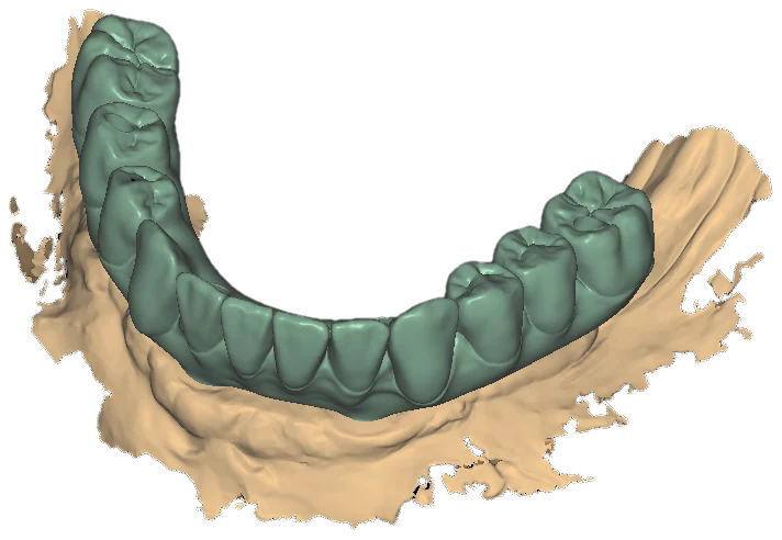 Occlusal view of a lower arch: teal designed crowns over an intraoral scan of sandy soft tissue with ragged scan edges