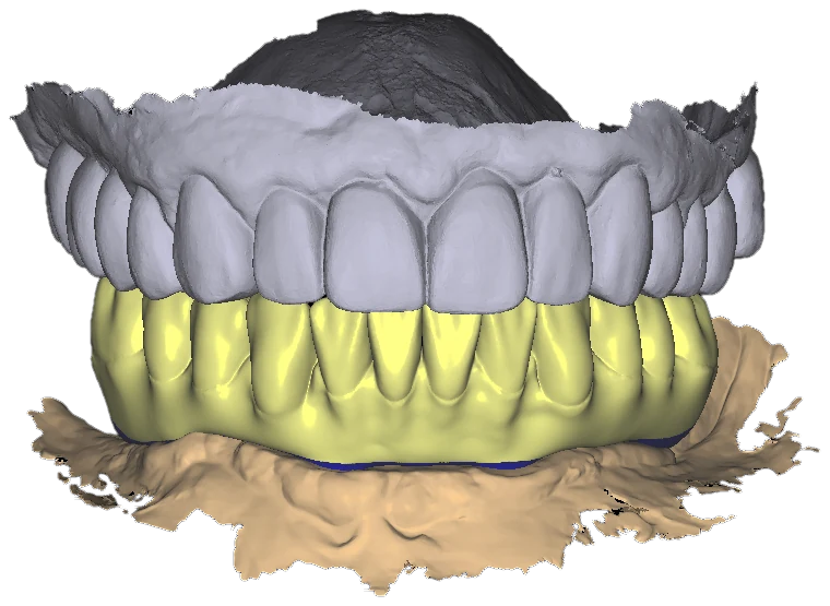 Frontal view of both arches in occlusion: gray scan of existing upper teeth over a yellow lower wax-up, sandy tissue below