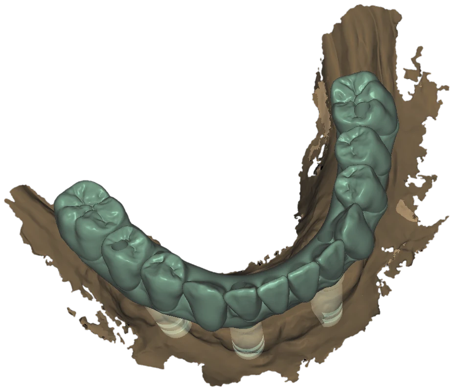 Occlusal view of a lower arch: teal crowns over dark-brown soft tissue with ghosted translucent scan-body and implant cylinders