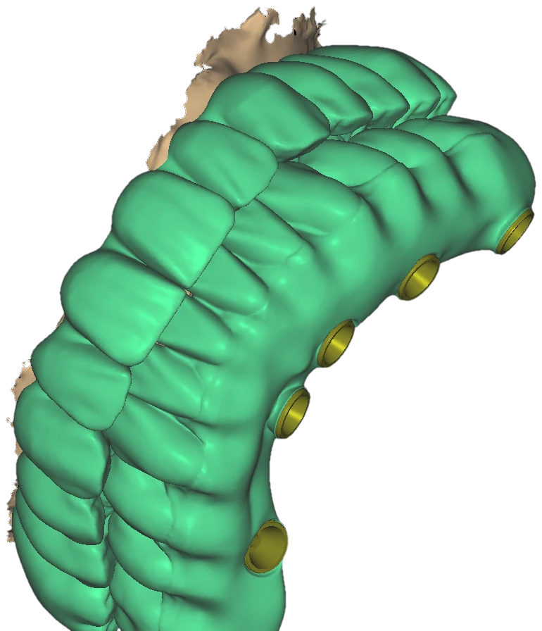 Close-up of a bright-green full-arch implant restoration from the basal side, yellow titanium-base rings around the screw channels
