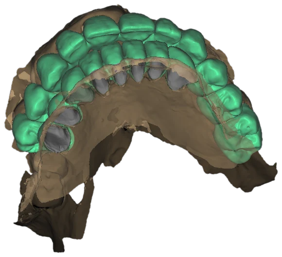 Occlusal-palatal view of an upper arch: green designed crowns over prepared gray teeth, brown tissue and palate