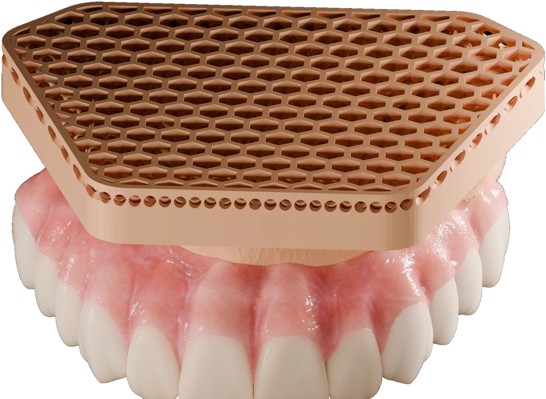 Photorealistic upper full-arch prosthesis with a rose-gold honeycomb framework floating above it, cut out on the dark page background