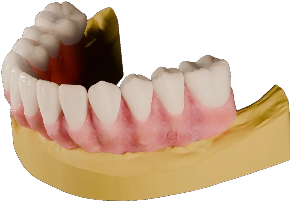 Photorealistic lower full-arch prosthesis on a gold model, three-quarter view, cut out on the dark page background