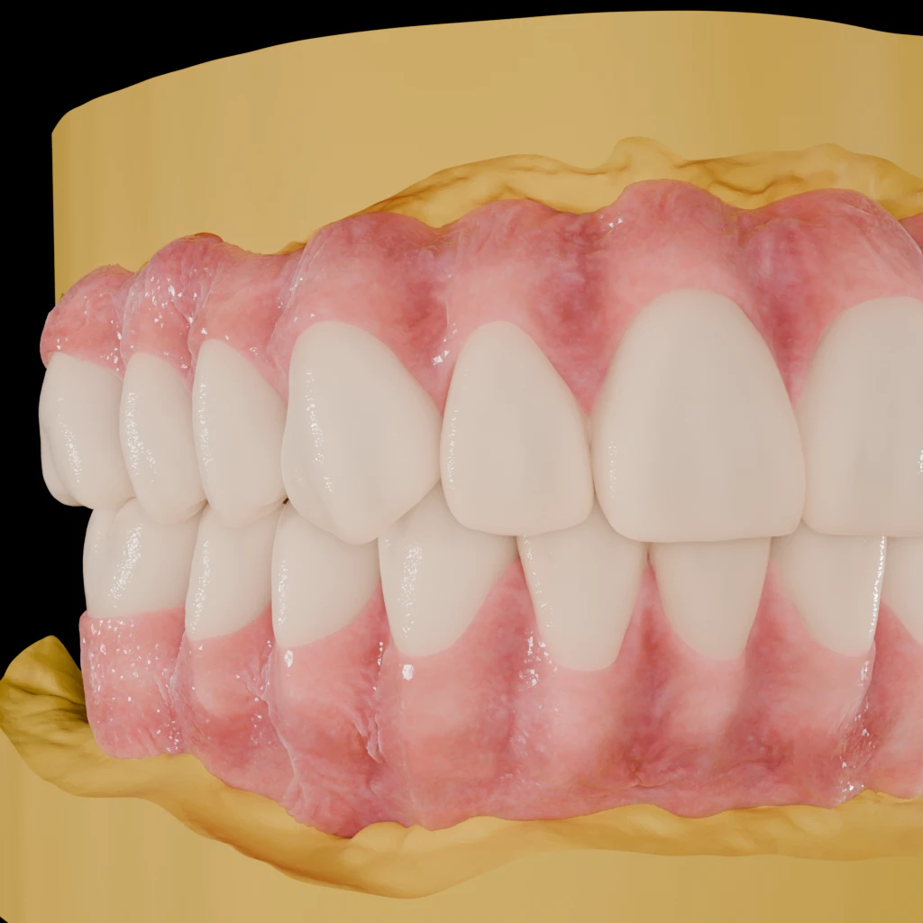 Photorealistic render of upper and lower arches in occlusion on yellow model bases, left lateral view
