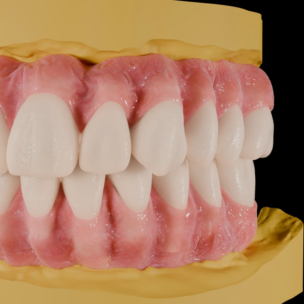 Photorealistic render of upper and lower arches in occlusion on yellow model bases, right lateral view