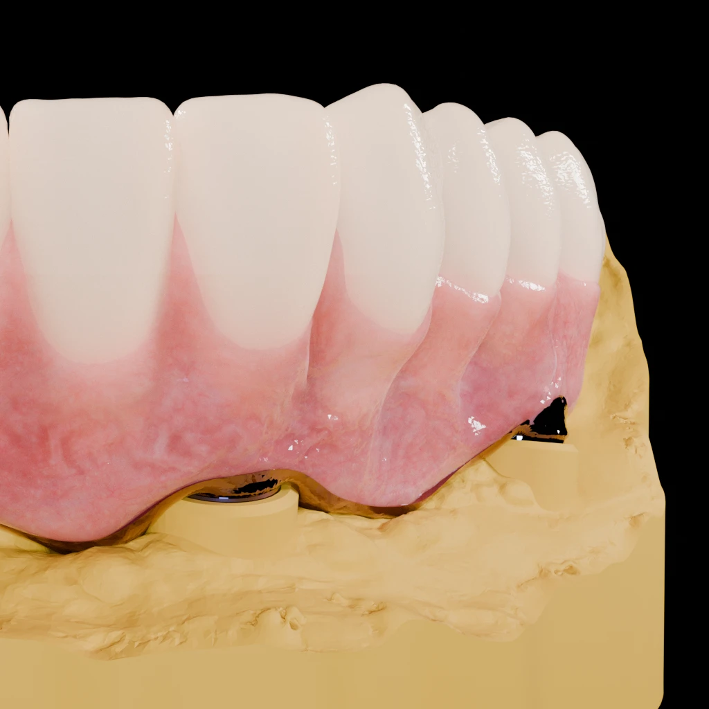 Photorealistic macro of lower incisors and canine on a yellow model, an implant analog visible in the model