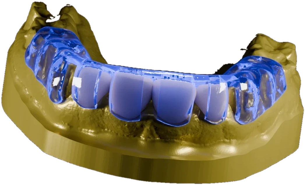 Photorealistic blue translucent reduction guide seated over white crowns on a gold model, cut out on the dark page background
