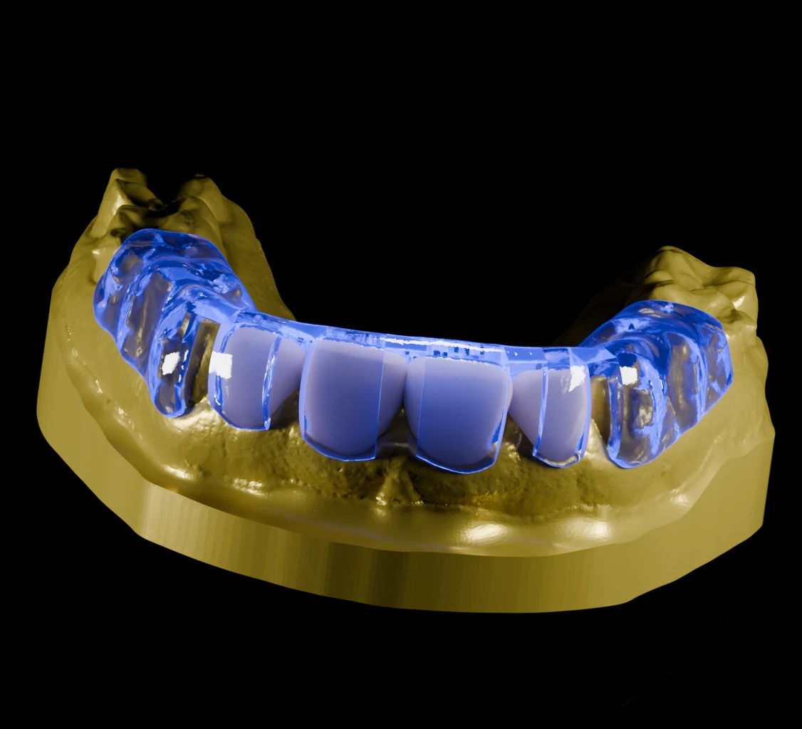 Photorealistic render of a translucent blue reduction guide seated over white crowns on a gold model