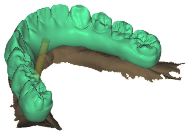 Upper arch design on abutments seen from above the side, with a yellow insertion-direction pin