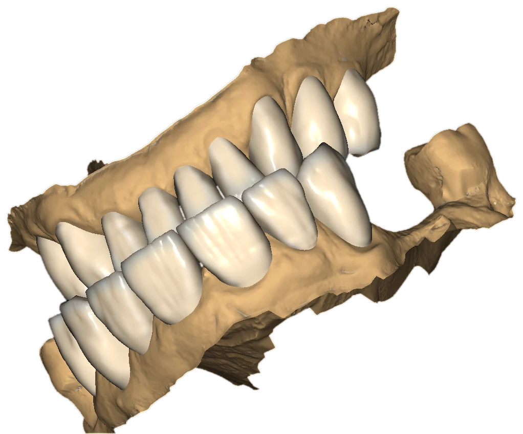 Lateral fragment of upper and lower monochrome full-arch designs in occlusion, exocad cutout