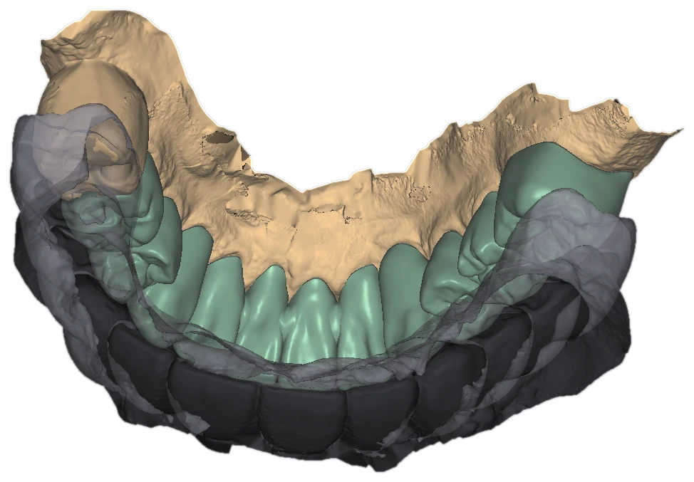Lower model with green prepared teeth, dark-gray temporaries and a transparent overlay, exocad cutout
