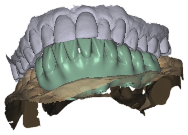 Frontal view of a white-lilac upper scan combined with a mint full-arch design on its base