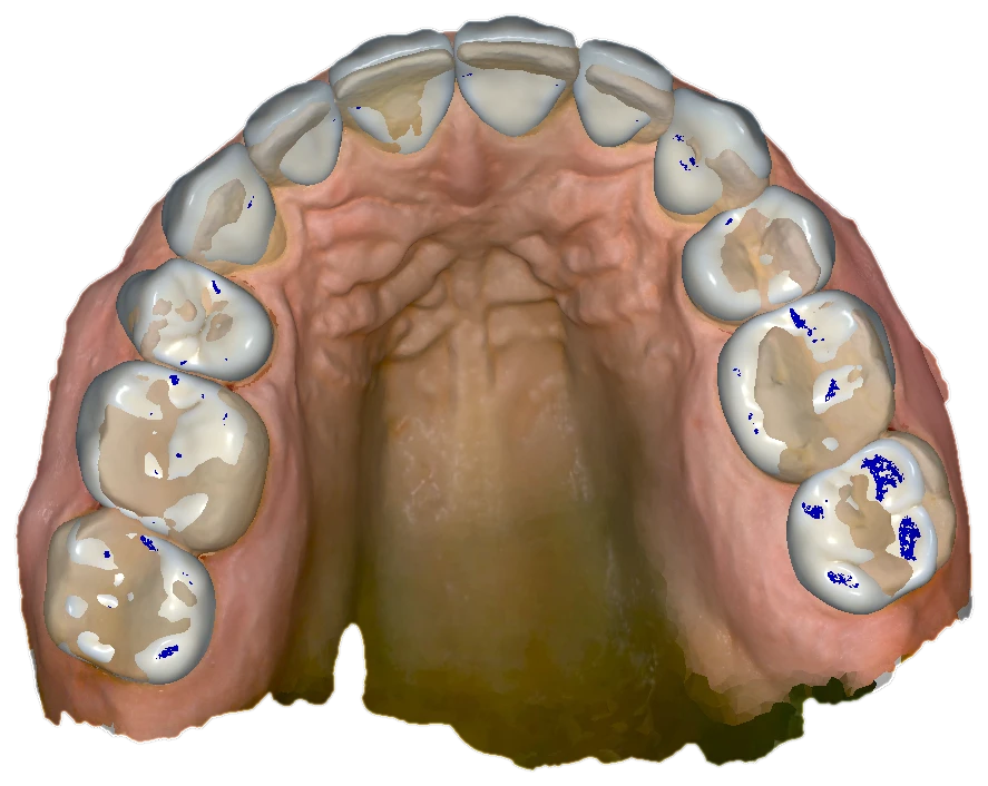 Occlusal view of an upper scan with photorealistic texture and white designed crowns, blue CAD occlusal contact marks