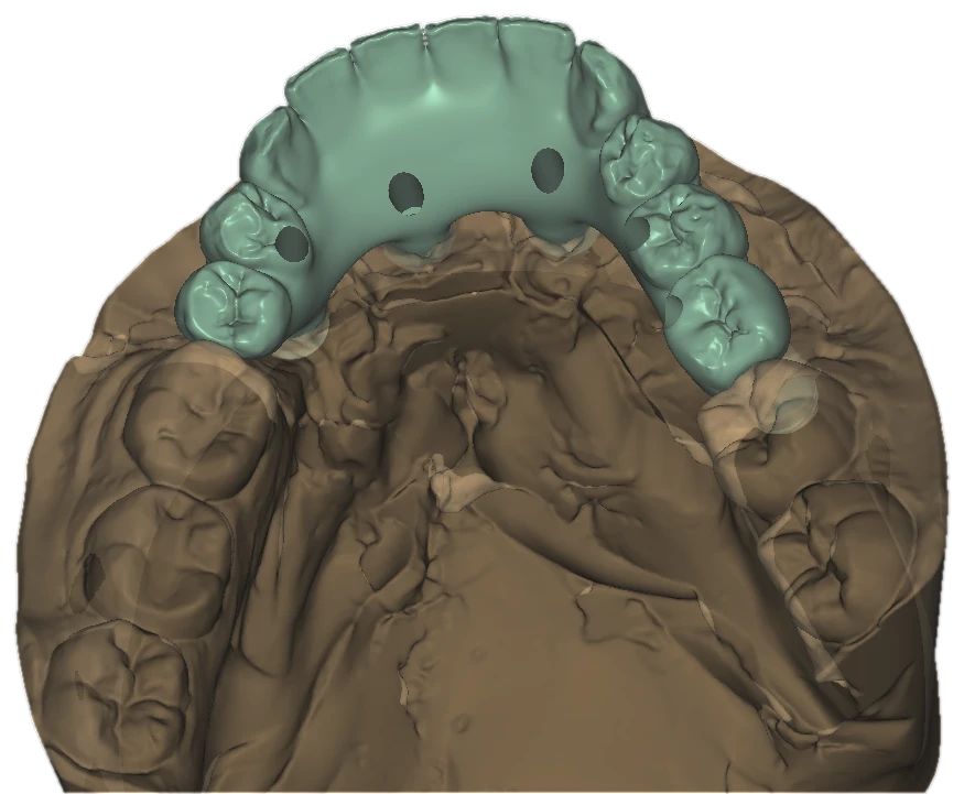 Top view of a green frontal bridge design seated on a brown intraoral scan