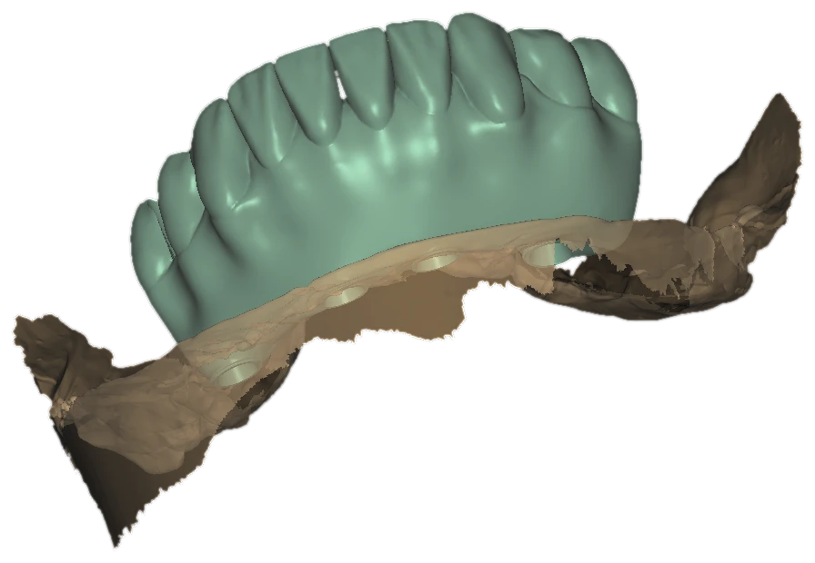 Full-arch design over a fragment of an intraoral scan, diagonal view, exocad cutout