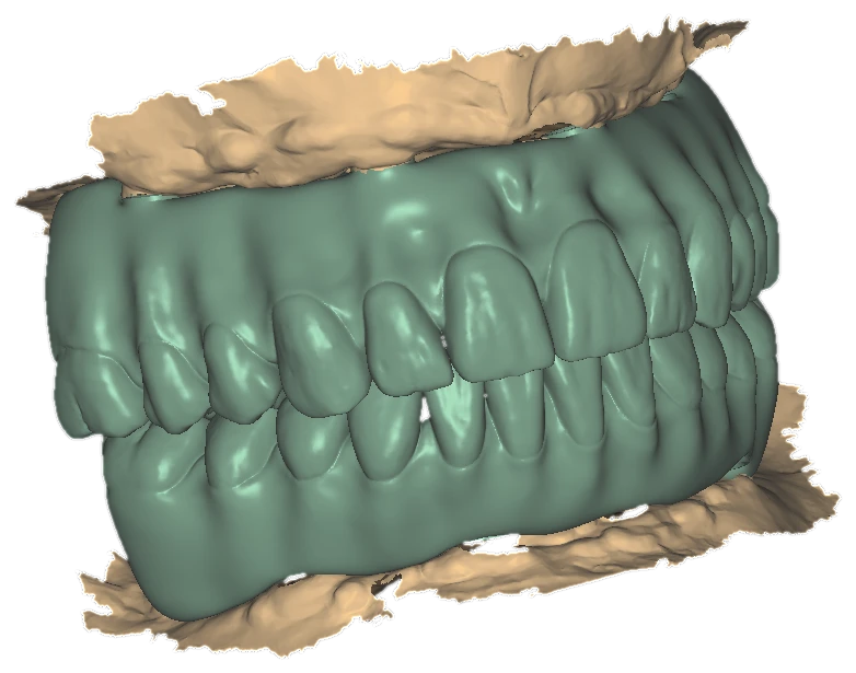 Upper and lower monolithic full-arch design in occlusion between two strips of intraoral scan, exocad cutout
