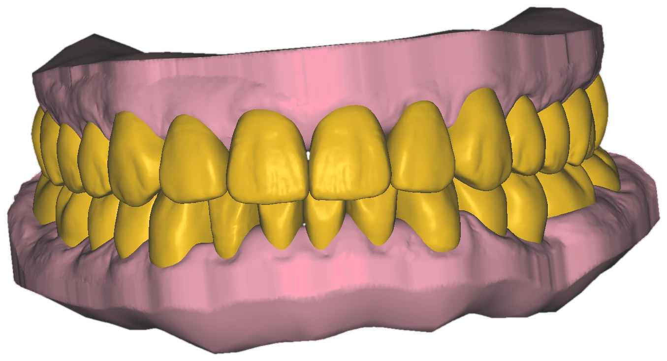 Pink model with golden-yellow diagnostic wax-up arches in occlusion, front view, exocad cutout